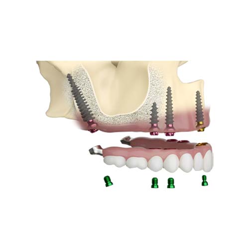 Pterygoid implants