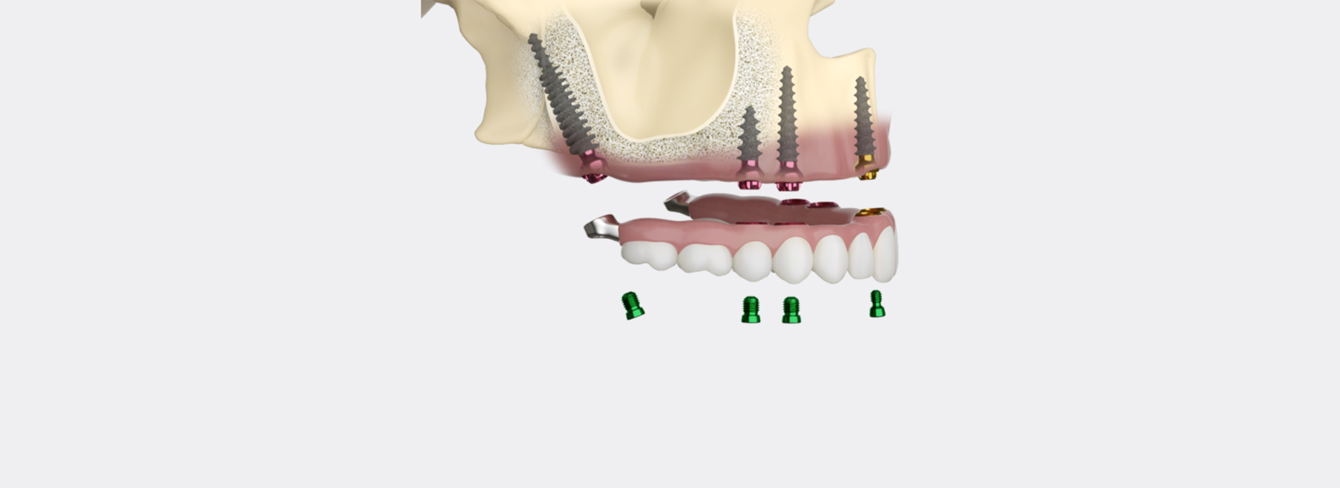 Pterygoid implants