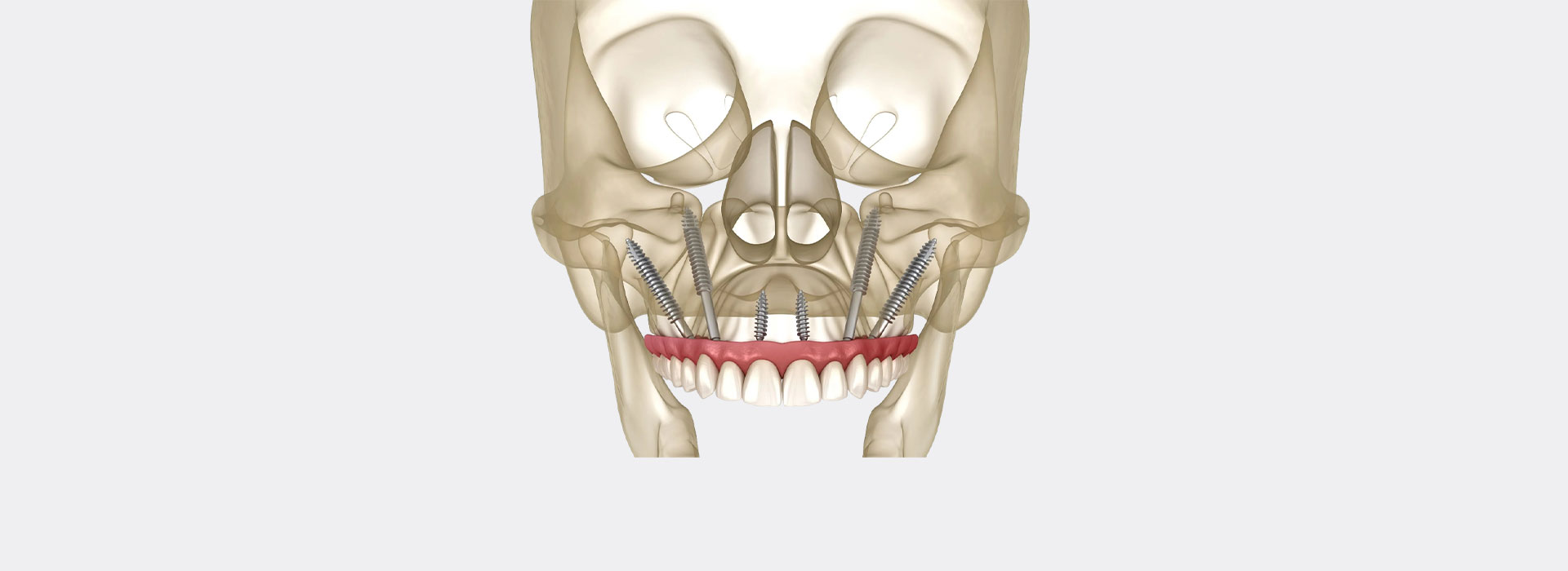 Zygomatic implants